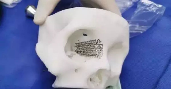 钛合金材料在眼眶骨折缺损修复中的应用(图2) 钛合金材料在眼眶骨折缺损修复中的应用(图2)
